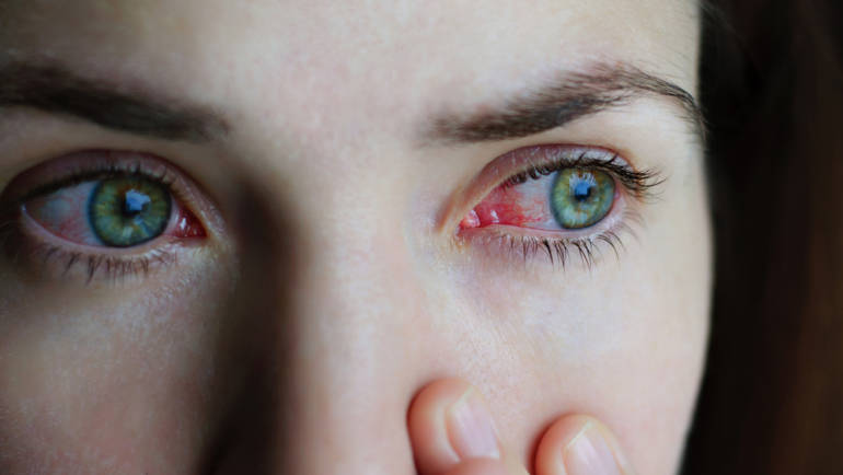 Dry Eyes, Red Eyes & Allergies